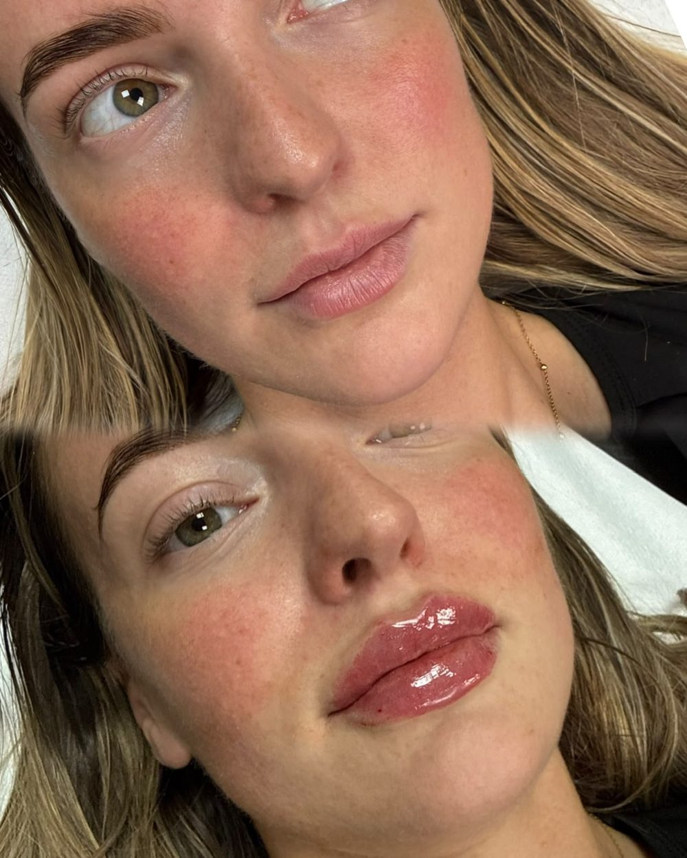 Before and after natural lip enhancement at Her Haus Aesthetics